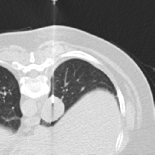 File:Carcinoid tumor - lung (Radiopaedia 44814-48644 Axial lung window 3).png