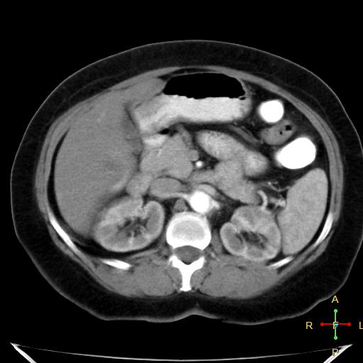 File:Carcinoma of sigmoid colon (Radiopaedia 23071-23100 C+ arterial phase 9).jpg
