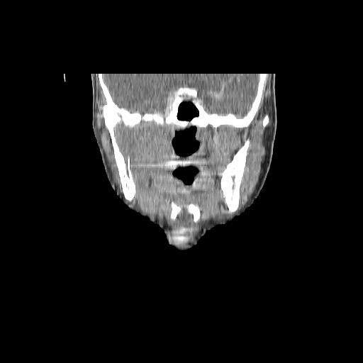 Carcinoma of the maxillary antrum (Radiopaedia 53805-59888 Coronal C+ delayed 74).jpg