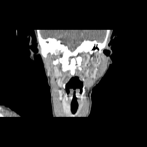 File:Carcinoma of the maxillary antrum (Radiopaedia 53805-59888 Coronal C+ delayed 99).jpg