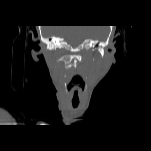 Carcinoma of the maxillary antrum (Radiopaedia 53805-59888 Coronal bone window 89).jpg