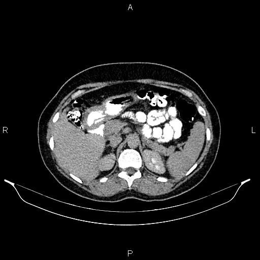 File:Carcinoma of uterine cervix (Radiopaedia 85861-101700 Axial C+ delayed 15).jpg