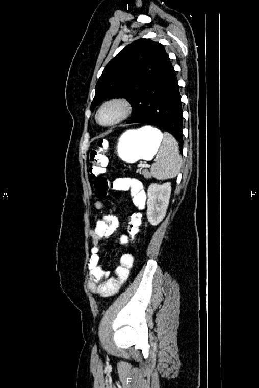 Carcinoma of uterine cervix (Radiopaedia 85861-101700 D 67).jpg