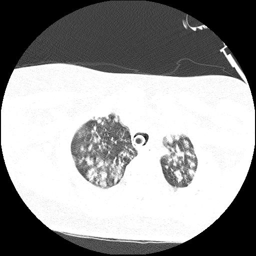 Cardiac angiosarcoma (Radiopaedia 66010-75181 Axial lung window 79).jpg