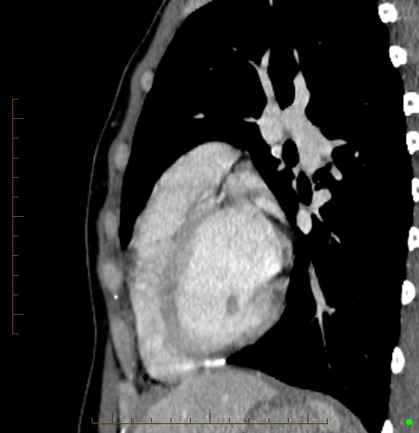 Cardiac paraganglioma (Radiopaedia 76345-88005 C 30).jpg