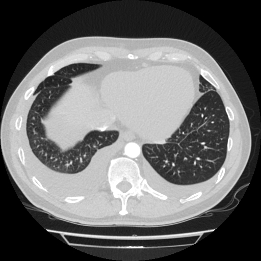 Cardiac tamponade (Radiopaedia 78607-91368 Axial lung window 74).jpg