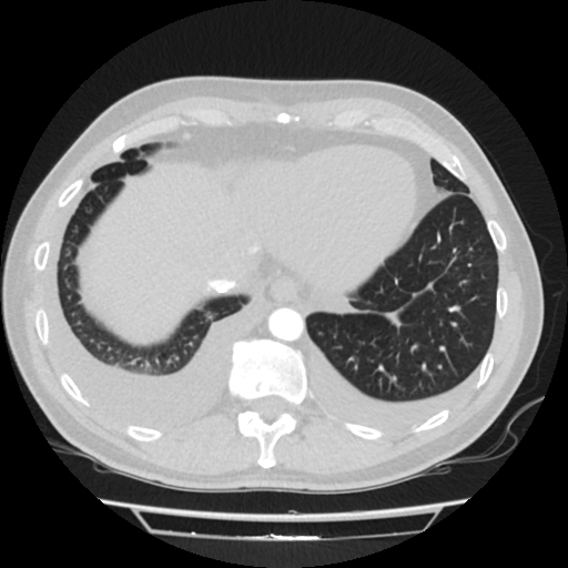 Cardiac tamponade (Radiopaedia 78607-91368 Axial lung window 77).jpg