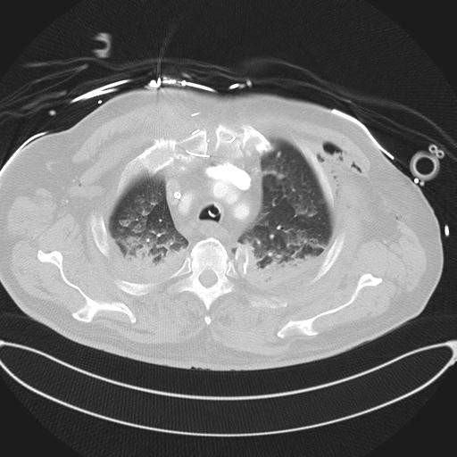 File:Cardiac trauma (Radiopaedia 32874-33858 Axial lung window 12).jpg