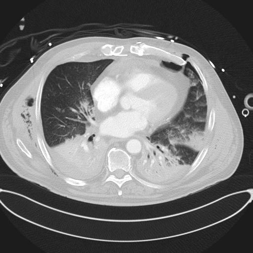 Cardiac trauma (Radiopaedia 32874-33858 Axial lung window 33).jpg