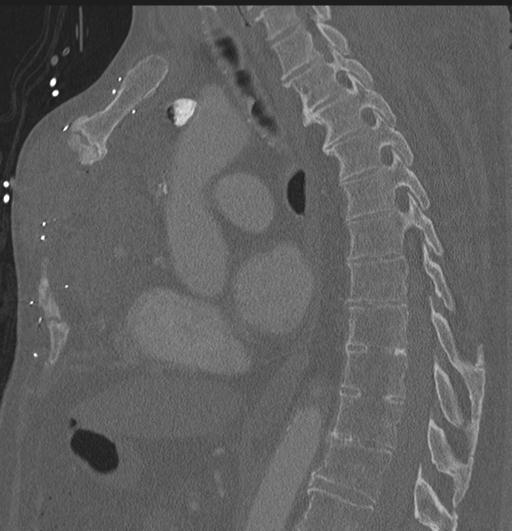 File:Cardiac trauma (Radiopaedia 32874-33858 Sagittal bone window 36).jpg