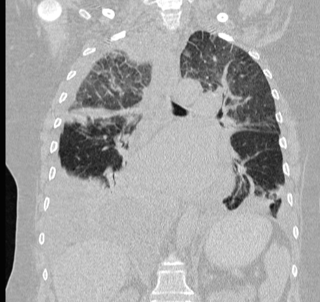 Cardiogenic pulmonary edema (Radiopaedia 29213-29609 Coronal lung window 40).jpg