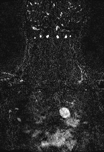 Carotid artery dissection (Radiopaedia 28441-28689 Coronal MRA 77).jpg