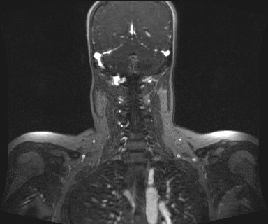 Carotid body tumor (Radiopaedia 12777-12912 MRA 53).jpg