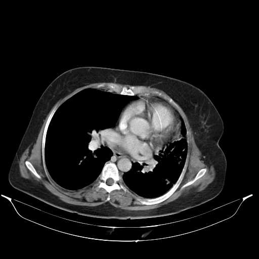 File:Carotid body tumor (Radiopaedia 21021-20948 A 39).jpg