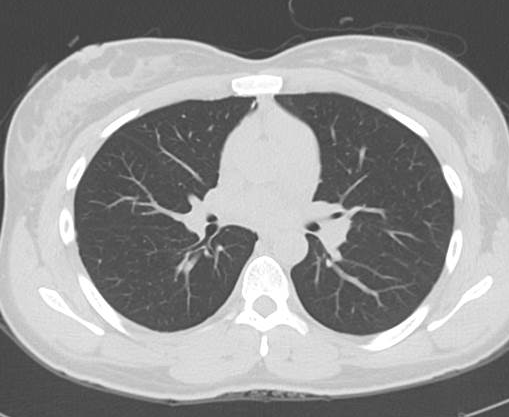 File:Catamenial pneumothorax (Radiopaedia 54382-60600 Axial 4).png