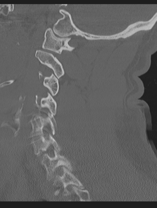 Cavernoma of cervical cord (Radiopaedia 50838-56346 Sagittal bone window 53).png