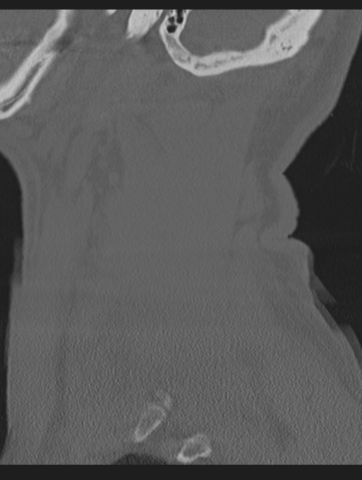 Cavernoma of cervical cord (Radiopaedia 50838-56346 Sagittal bone window 69).png