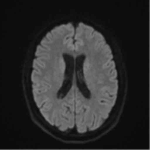 File:Cavernoma with bleed - midbrain (Radiopaedia 54546-60774 Axial DWI 44).png
