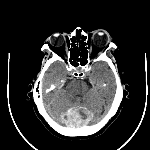 Cavernous hemangioma of the cerebellar falx (Radiopaedia 73025-83723 Axial non-contrast 42).jpg