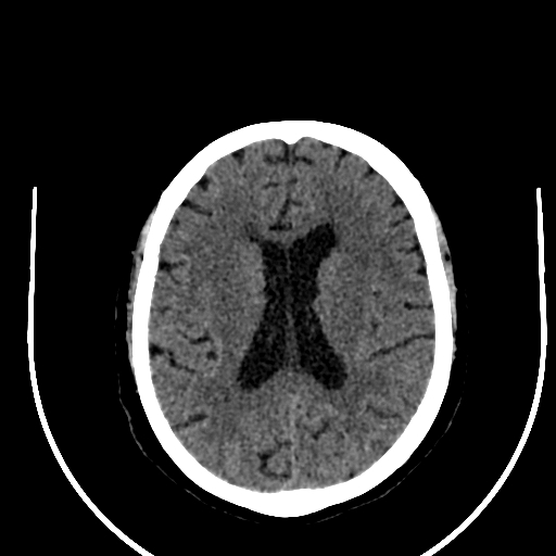 Cavernous hemangioma of the cerebellar falx (Radiopaedia 73025-83723 Axial non-contrast 84).jpg