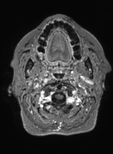 Cavernous hemangioma of the cerebellar falx (Radiopaedia 73025-83724 Axial T1 C+ 340).jpg