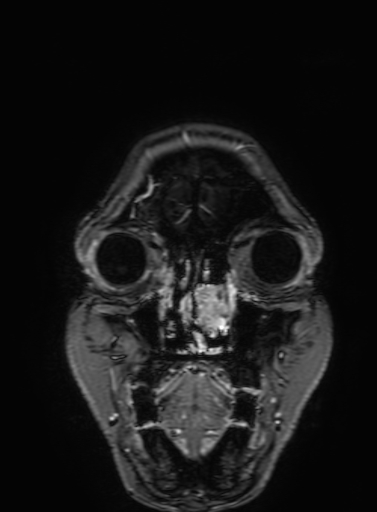 Cavernous hemangioma of the cerebellar falx (Radiopaedia 73025-83724 Coronal T1 C+ 29).jpg