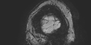 File:Cavernous hemangioma of the cerebellar falx (Radiopaedia 73025-83724 Sagittal BOLD 8).jpg