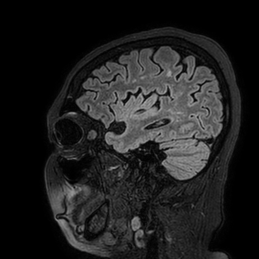 Cavernous hemangioma of the cerebellar falx (Radiopaedia 73025-83724 Sagittal FLAIR 44).jpg