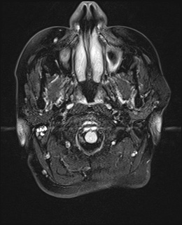 File:Cavernous sinus meningioma (Radiopaedia 63682-72367 Axial FLAIR 2).jpg