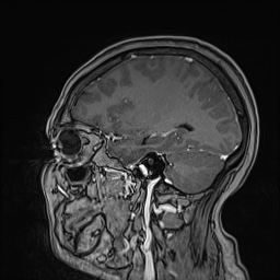 Cavernous sinus meningioma (Radiopaedia 63682-72367 Sagittal T1 C+ 119).jpg