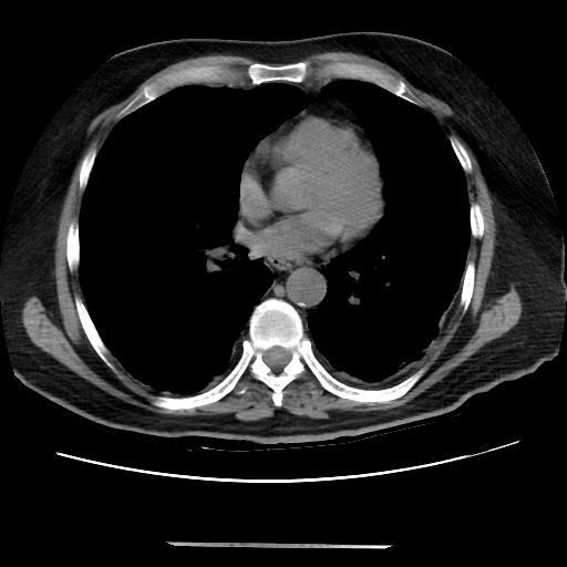 Cavitating pulmonary metastases (Radiopaedia 89545-106544 Axial non-contrast 34).jpg