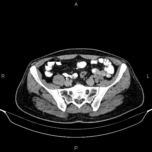 Cecal adenocarcinoma (Radiopaedia 85324-100916 Axial C+ delayed 74).jpg