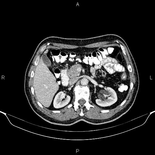 Cecal adenocarcinoma (Radiopaedia 85324-100916 B 32).jpg
