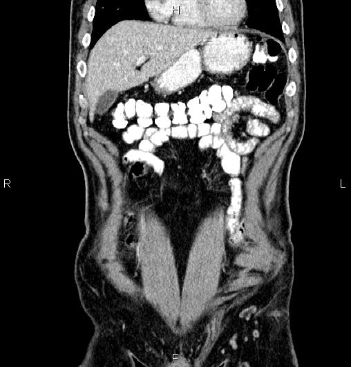 Cecal adenocarcinoma (Radiopaedia 85324-100916 D 15).jpg