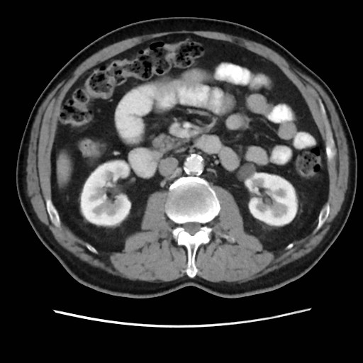Cecal mass causing appendicitis (Radiopaedia 59207-66531 A 39).jpg