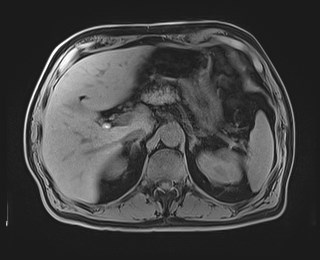 Cecal mass causing appendicitis (Radiopaedia 59207-66532 Axial T1 41).jpg