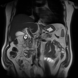 File:Cecal mass causing appendicitis (Radiopaedia 59207-66532 Coronal T2 18).jpg