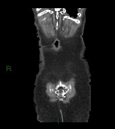 Cecal volvulus (Radiopaedia 86741-102900 B 6).jpg