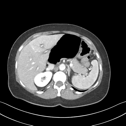 Cecum hernia through the foramen of Winslow (Radiopaedia 46634-51112 A 20).png