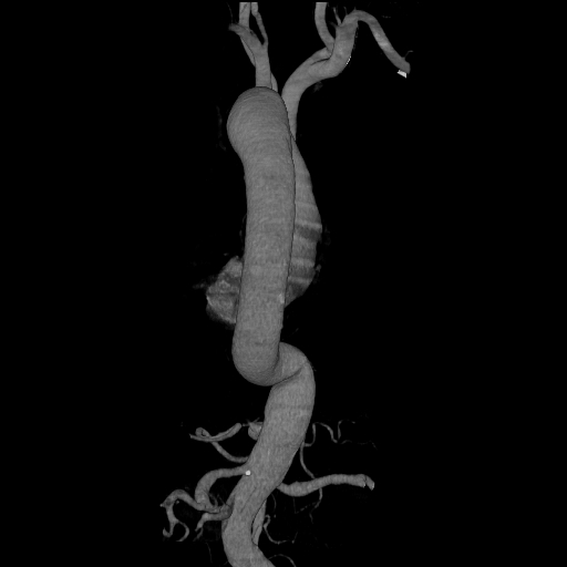 File:Celiac artery aneurysm (Radiopaedia 21574-21525 C 9).JPEG