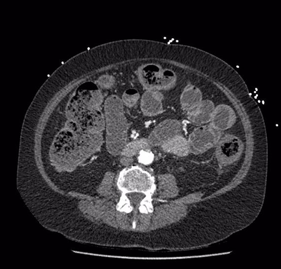 Celiac artery severe stenosis and dissection (Radiopaedia 44128-47842 B 52).jpg