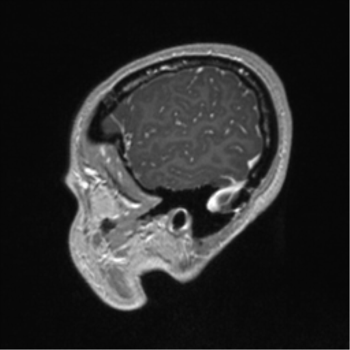 Central neurocytoma (Radiopaedia 37664-39557 Sagittal T1 C+ 16).png