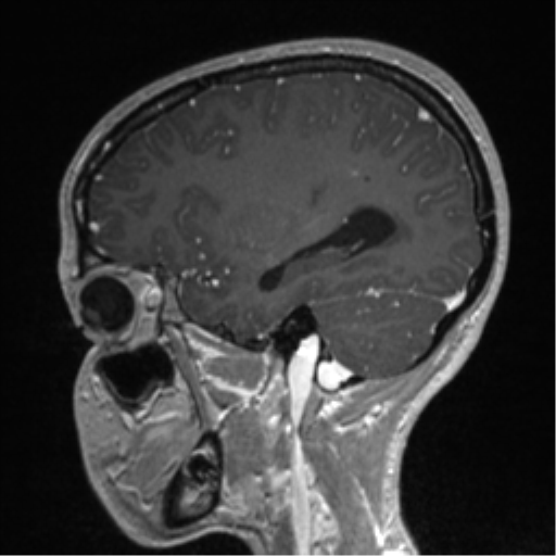 Central neurocytoma (Radiopaedia 37664-39557 Sagittal T1 C+ 69).png