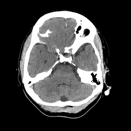 File:Central neurocytoma (Radiopaedia 68725-78432 Axial non-contrast 13).jpg