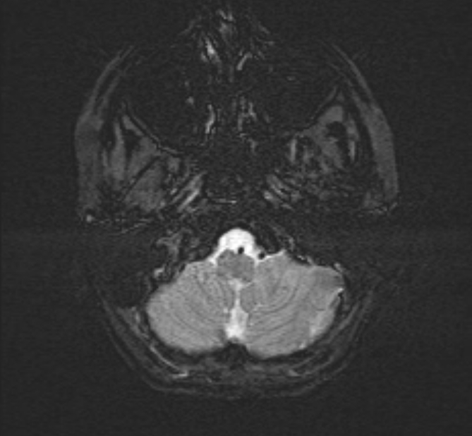 Central neurocytoma (Radiopaedia 70263-80336 Axial SWI 4).jpg