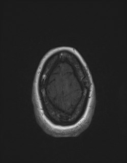 Central neurocytoma (Radiopaedia 84497-99872 Axial T1 172).jpg