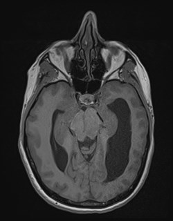 Central neurocytoma (Radiopaedia 84497-99872 Axial T1 80).jpg