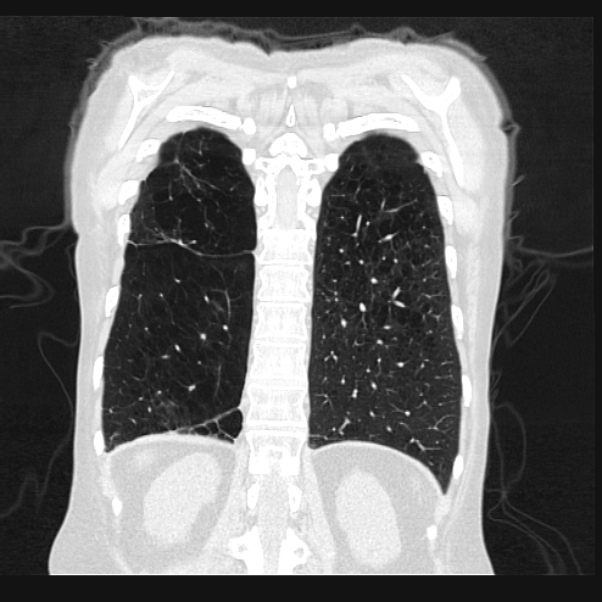 Centrilobular pulmonary emphysema (Radiopaedia 24495-24789 Coronal lung window 62).jpg
