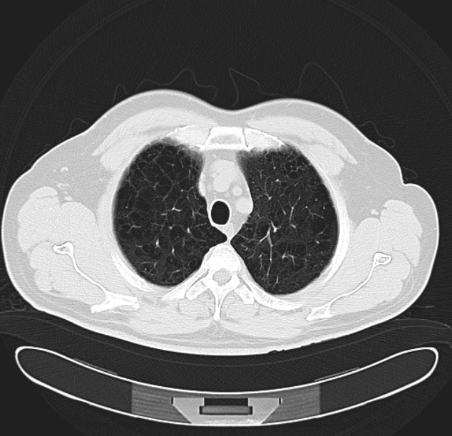 Centrilobular pulmonary emphysema (Radiopaedia 26808-26971 C 8).jpg