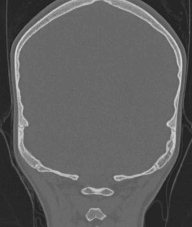 Cerebellar abscess (Radiopaedia 73727-84527 Coronal bone window 9).jpg